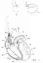 Fig. 02 - LEAD SHAPED FOR STIMULATION AT THE BASE LEFT VENTRICLE