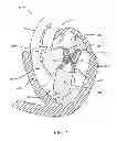 Fig. 02 - Transcatheter mitral valve prosthesis