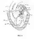 Fig. 06 - Transcatheter mitral valve prosthesis