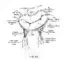 Fig. 07 - Transcatheter mitral valve prosthesis