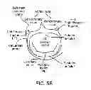 Fig. 08 - Transcatheter mitral valve prosthesis