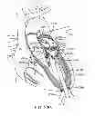 Fig. 35 - Transcatheter mitral valve prosthesis