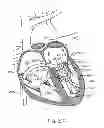 Fig. 41 - Transcatheter mitral valve prosthesis