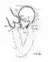 Fig. 43 - Transcatheter mitral valve prosthesis
