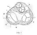 Fig. 02 - Method for stabilizing a cardiac valve annulus