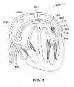 Fig. 06 - Method for stabilizing a cardiac valve annulus