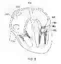 Fig. 07 - Method for stabilizing a cardiac valve annulus