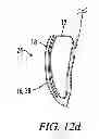 Fig. 04 - Breast implant assembly