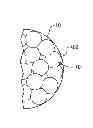 Fig. 01 - HYBRID BREAST IMPLANT AND TISSUE EXPANDER, METHODS OF MAKING AND USE OF SAME