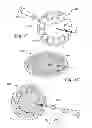 Fig. 09 - HYBRID BREAST IMPLANT AND TISSUE EXPANDER, METHODS OF MAKING AND USE OF SAME
