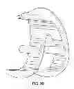 Fig. 137 - Patient-adapted and improved articular implants, designs and related guide tools