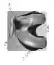 Fig. 167 - Patient-adapted and improved articular implants, designs and related guide tools