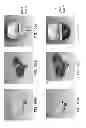 Fig. 197 - Patient-adapted and improved articular implants, designs and related guide tools