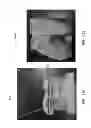 Fig. 216 - Patient-adapted and improved articular implants, designs and related guide tools