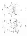 Fig. 22 - Patient-adapted and improved articular implants, designs and related guide tools