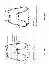 Fig. 33 - Patient-adapted and improved articular implants, designs and related guide tools