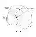 Fig. 49 - Patient-adapted and improved articular implants, designs and related guide tools