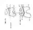 Fig. 65 - Patient-adapted and improved articular implants, designs and related guide tools