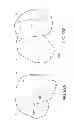 Fig. 80 - Patient-adapted and improved articular implants, designs and related guide tools