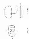 Fig. 99 - Patient-adapted and improved articular implants, designs and related guide tools