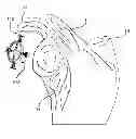 Fig. 01 - GLENOID VAULT FIXATION SYSTEM