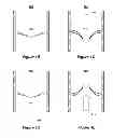 Fig. 03 - Implantable device for directional control of flow within the anatomic tracts of the body