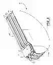 Fig. 03 - Implantable cardioverter defibrillator capacitor assembly with flex circuit