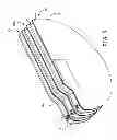 Fig. 04 - Implantable cardioverter defibrillator capacitor assembly with flex circuit