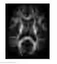 Fig. 01 - Transformation method for diffusion spectrum imaging using large deformation diffeomorphic metric mapping