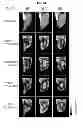Fig. 03 - Use of pyruvate or succinate to enhance the efficacy of a hypoxia activated prodrug for the treatment of tumors