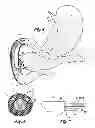 Fig. 04 - Fiber optic imaging catheter