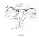 Fig. 06 - METHODS AND DEVICES FOR DETERMINING LUMEN OCCLUSION