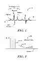 Fig. 02 - Robust rate calculation in an implantable cardiac stimulus or monitoring device