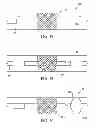 Fig. 09 - Apparatus and methods for clot disruption and evacuation