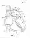 Fig. 06 - Apparatus and methods for facilitating treatment of tissue via improved delivery of energy based and non-energy based modalities