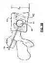 Fig. 07 - Method for balloon-aided vertebral augmentation