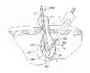 Fig. 01 - Surgical retrieval apparatus