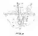 Fig. 07 - Surgical retrieval apparatus