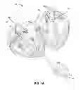 Fig. 02 - Shockwave valvuloplasty with multiple balloons