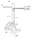 Fig. 07 - Shockwave valvuloplasty with multiple balloons