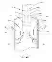 Fig. 08 - Shockwave valvuloplasty with multiple balloons