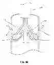 Fig. 09 - Shockwave valvuloplasty with multiple balloons