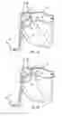 Fig. 06 - Needleless transseptal access device and methods