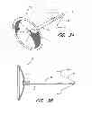 Fig. 03 - DEVICE FOR LEFT ATRIAL APPENDAGE OCCLUSION