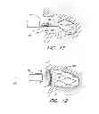 Fig. 08 - DEVICE FOR LEFT ATRIAL APPENDAGE OCCLUSION