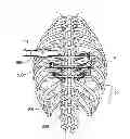 Fig. 01 - Systems, assemblies and methods for spinal derotation