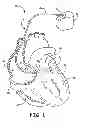 Fig. 02 - REINFORCED COIL CREATED FROM POLYMER COATED WIRE FOR IMPROVED TORQUE TRANSFER