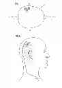 Fig. 02 - NEURAL BLOCKING THERAPY