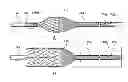 Fig. 01 - Stent delivery systems and associated methods