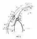 Fig. 03 - Ocular collar stent for treating narrowing of the irideocorneal angle